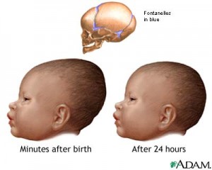newborn-head-molding